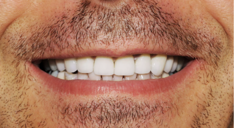 After — full restoration at D'Arcy Dental Okotoks