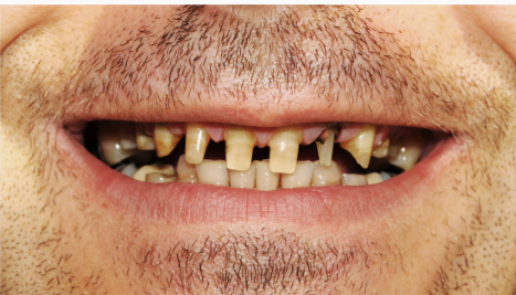 Before — full restoration at D'Arcy Dental Okotoks