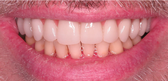 After — teeth whitening at D'Arcy Dental Okotoks